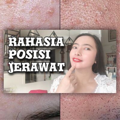 Rahasia posisi jerawat pada wajah ❤️LOH#31, Kulit#4❤️