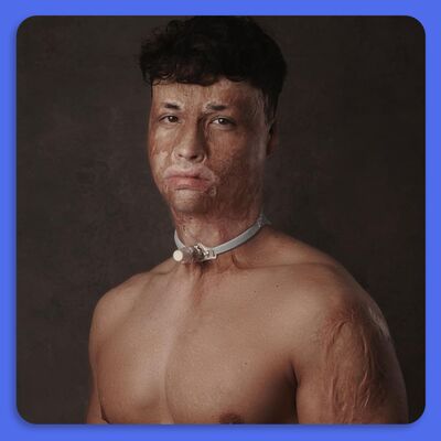 Als 6-jarig jongetje verbrand door kerstboomverlichting