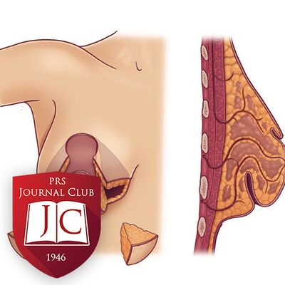 “McKissock for Secondary Mammaplasty” with Elizabeth Hall-Findlay, MD - Apr. 2025 Journal Club