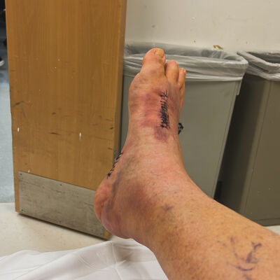 Intervals FrankenFoot