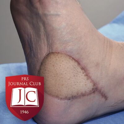 “The Superthin ALT Flap” with Edward I. Chang, MD - Feb. 2025 Journal Club