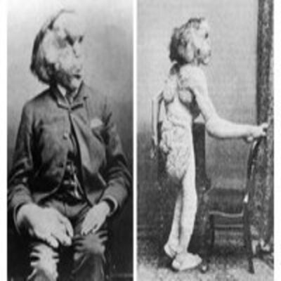 RUMBO INFINITO 09-05-2014 Joseph Merrick: la lucha del 'Hombre Elefante'