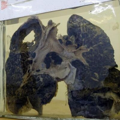 10. La tuberculosis, la enfermedad más antigua de la humanidad