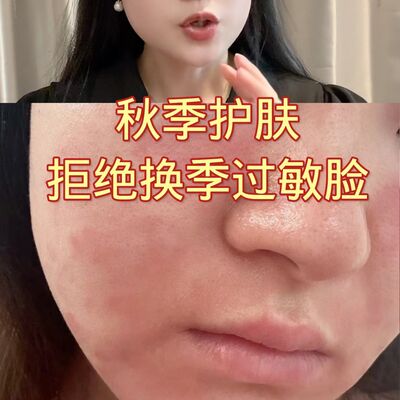 秋季护肤，拒绝换季过敏脸，一到换季就过敏太难受了
