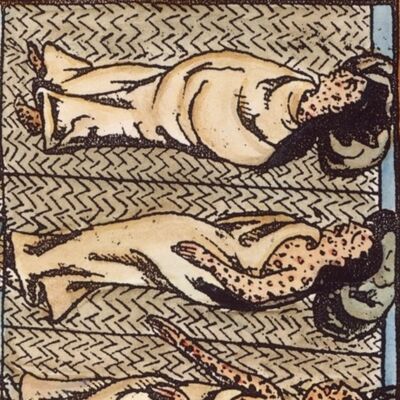 12. El sarampión, desde la conquista de América hasta el movimiento antivacunas