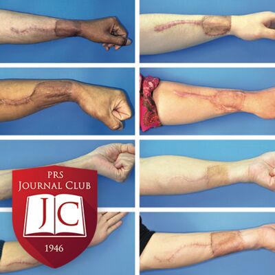 “Radial and Ulnar Forearm Free Flaps” with Valeriy Shubinets, MD - Sept. 2024 Journal Club