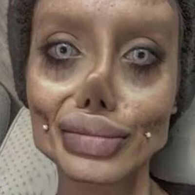 Apesnya Operasi Plastik