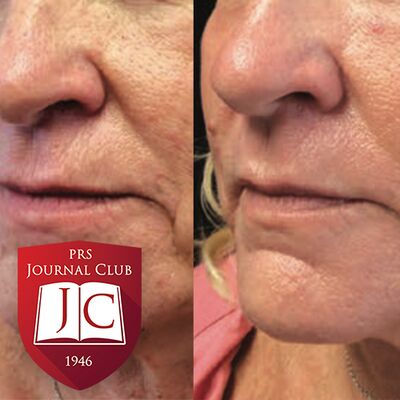 “PROs after Facial Laser Resurfacing” with Lara Devgan, MD, MPH - Jul. 2025 Journal Club