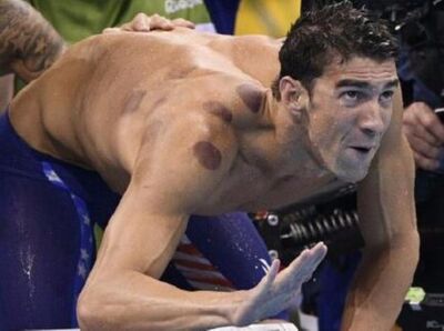 【卓老板看奥运】菲尔普斯的拔火罐