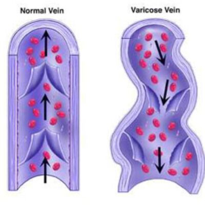 下肢靜脈曲張可以重量訓練嗎?