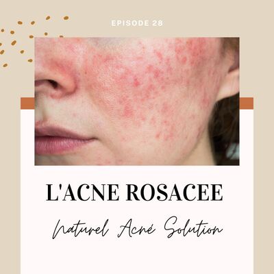 Episode 28 - L'acné rosacée
