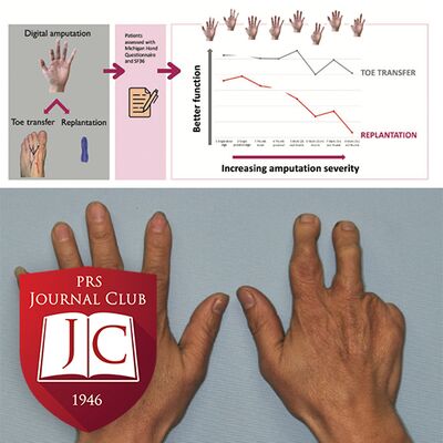 “Toe Transfers Outperform Replantation” with James Higgins, MD - Aug. 2025 Journal Club